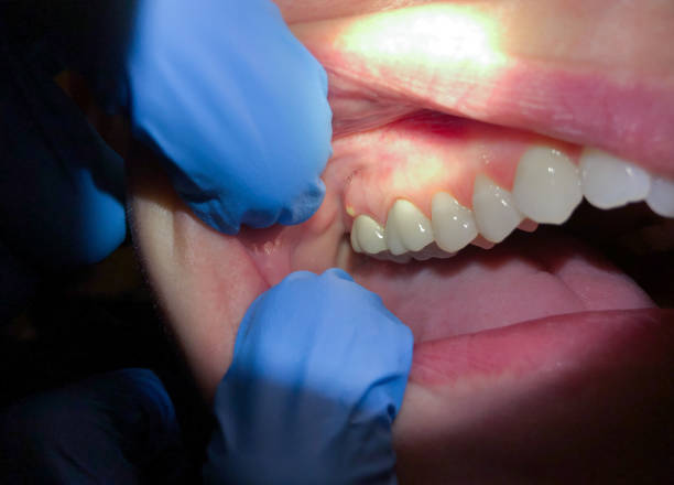 Best Emergency Dentist for Lost Fillings or Crowns in Wesley Chapel, NC